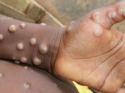 Côte d’Ivoire : deux cas de Variole du Singe ou Monkeypox enregistrés à Tabou et à Koumassi