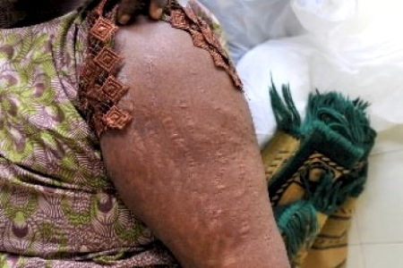 Dossier / Dépigmentation de la peau : Les femmes en danger !