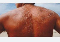 Cancers de la peau : Attention aux rayons solaires