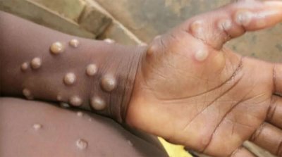 Mpox: 1.100 décès en Afrique, mise en garde de l’agence sanitaire de l’UA