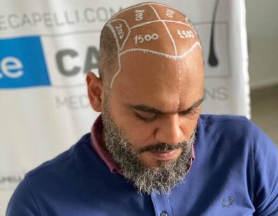 Publireportage- Greffe capillaire : la clinique Estecapelli annonce la poursuite de son offre promotionnelle à Abidjan