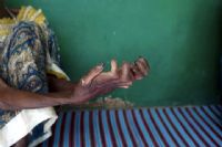 Journée mondiale des lépreux : 49 nouveaux cas enregistrés à Daloa