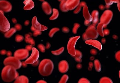 Santé: la Drépanocytose, cette tueuse silencieuse !