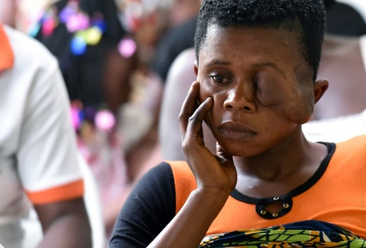 Côte d’Ivoire: rendre le sourire aux victimes du noma, maladie qui défigure et exclut